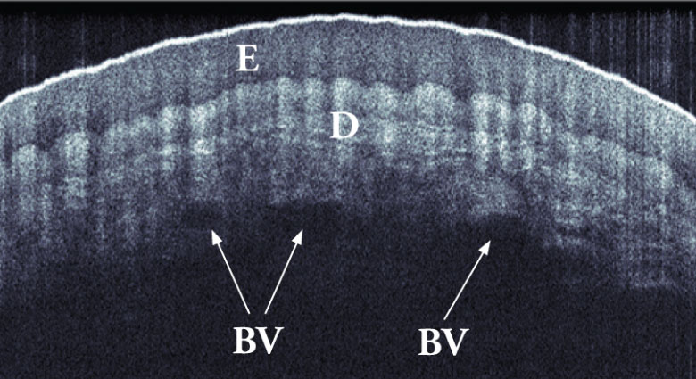 OCTアトラス OCTアトラス Optical Coherence Tomography - OCT